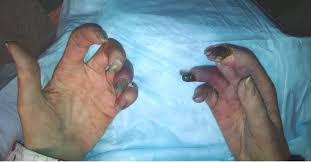 Attēlu rezultāti vaicājumam “Scleroderma”