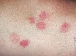 Image result for bed bug bites