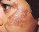 Introduction to Melasma: