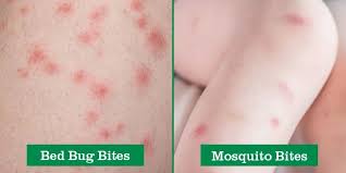Image result for bed bug bites