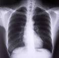 Chronic Obstructive Pulmonary Disease