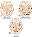 <b>EPILEPSY</b> DIAGNOSIS