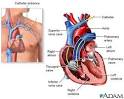 Swan-Ganz Catheters » Health Informations