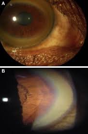 Kuvahaun tulos haulle Kayser-Fleischer