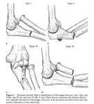 of <b>Monteggia Fracture</b>