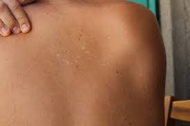 Image result for tinea corporis