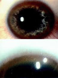 Kuvahaun tulos haulle Kayser-Fleischer