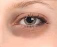 Dark circles under eyes