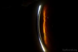 Kuvahaun tulos haulle Kayser-Fleischer