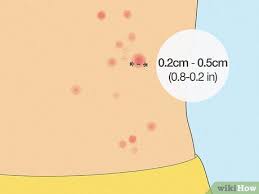 Image result for bed bug bites