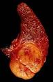 <b>Follicular</b> adenoma of the