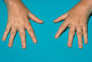 <b>Juvenile Rheumatoid Arthritis</b>