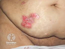 Attēlu rezultāti vaicājumam “Pemphigus borealis”