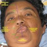 <b>NERVIO</b> FACIAL