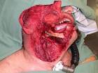 Photos of the effects of smokeless tobacco - my cancer story