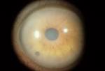 <b>Corneal edema</b>