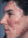 Acne Symptoms on the Face