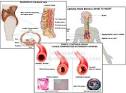 <b>Unstable angina</b> defense