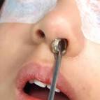 Pictures of <b>Foreign Body</b> in the Nose * OTOLARYNGOLOGY HOUSTON