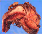 <b>Jaw tumors</b> in African boys