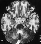 <b>Canavan disease</b> in a
