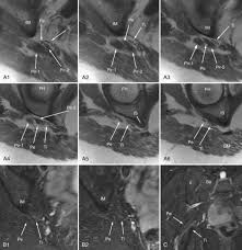 Attēlu rezultāti vaicājumam “Cribraria piriformis young”