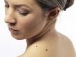 Moles and skin cancer facts