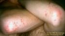 <b>dermatite herpetiforme</b>