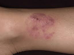 Image result for tinea corporis