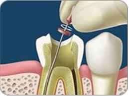 que-es-una-endodoncia