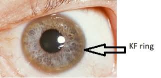 Kuvahaun tulos haulle Kayser-Fleischer