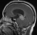 File:Tumor <b>Germinoma</b>