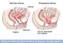 Uterine Prolapse - Physiopedia- the free resource for the ...