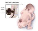 <b>Spina bifida</b> malformations