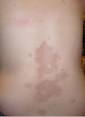 <b>Scleroderma</b>