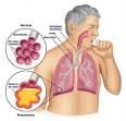 Pneumonia - FirstCare Walk-In Medical Center