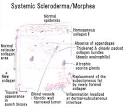 <b>Systemic scleroderma</b>, Morphea