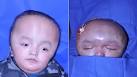 June 1, 2012. Seven-year-old Dawa Titung grew up in Nepal with a head the