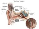 Cochlear Implants