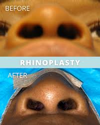 Image result for rupaljanuj