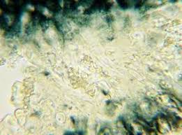 Attēlu rezultāti vaicājumam “Megalaria grossa”