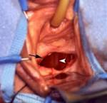 Fistulas of the Genitourinary Tract: A Radiologic Review1