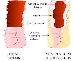 Image result for boala crohn si schizofrenie paranoida