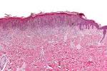 File:<b>Pigmented</b> spindle cell