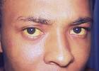 Slika:Jaundice eye.jpg