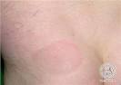 <b>Erythema Chronicum Migrans</b>