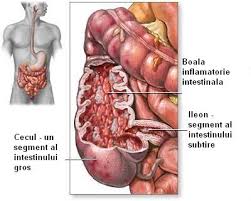 Image result for boala crohn si schizofrenie paranoida