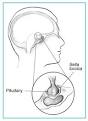 How common is <b>prolactinoma</b>?