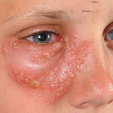 Attēlu rezultāti vaicājumam “Diderma simplex sessile”