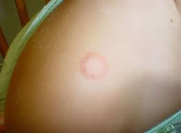 Image result for tinea corporis